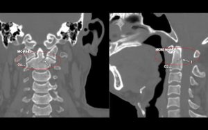 Không có triệu chứng đau nhức, người bệnh bất ngờ được chẩn đoán gãy mỏm nha đốt sống cổ